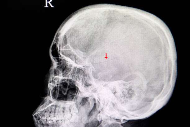 A skull X-ray film of a Traumatic Brain Injury patient showing a temporoparietal linear fracture of the skull